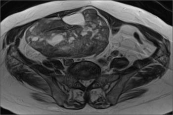 Axial T2WI shows a heterogeneous, predominantly hypointense left ovarian mass.