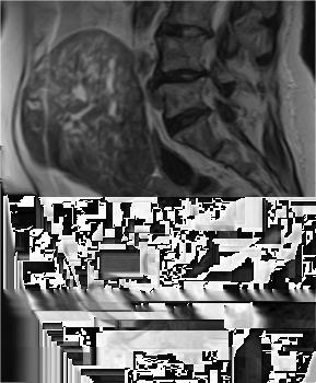 Sagittal T2WI shows a heterogeneous, predominantly hypointense left ovarian mass, that