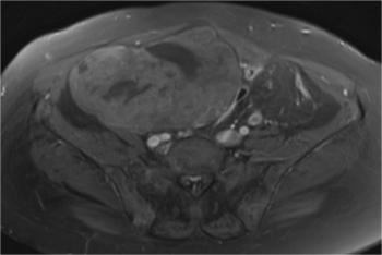 isointense to peritoneal fluid seen in the pelvic cavity.