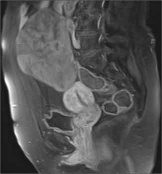 Sagittal fat-supressed gadolinium-enhanced T1WI shows mild enhancement of the left ovarian mass (less than myometrium). Note there is no attachment between the lesion and the uterine fundus.