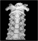 Trauma Cx Spine Protocols Cervical Spine Trauma Issues The clinically negative Cx-spine Do