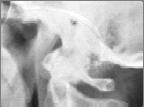degrees Still does not indicate instability Negative study does not indicate stability Cx-Spine Signs of Instability
