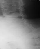 and neck without axial compression Unilateral Facet Dislocation Simultaneous flexion and rotation Best seen on lateral and oblique views Vertebral body subluxation < ½ of AP width Disrupted shingles
