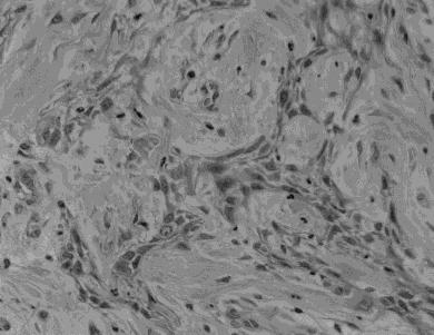 Spindle cell nuclear atypia was absent in 9 cases and was minimal in 21 cases. The spindle cells appeared mainly isolated or were arranged in wavy, interlacing fascicles.
