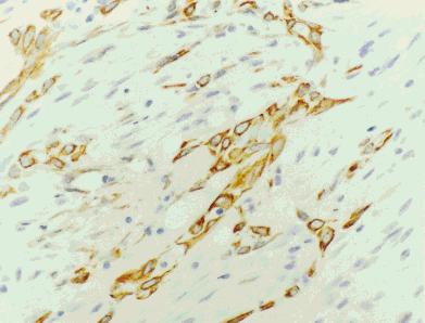 Metaplastic Fibromatosis of the Breast/Gobbi et al. 2175 TABLE 4 Immunohistochemical Results a Antibody No. of positive cases/no. of cases tested AE1/AE3 10/11 HMW-K 12/16 CAM 5.