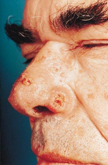 914 C.ESCHE et al. Figure 1. A 62-year-old with 3-year history of facial papules. kerathoacanthoma. The biopsies of 16 facial papules showed sebaceous adenoma, epithelioma and hyperplasia.