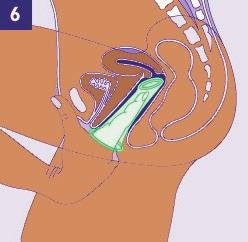 The inner ring should be pushed just past the pubic bone and over the cervix. 2. After insertion, make sure the condom is not twisted.
