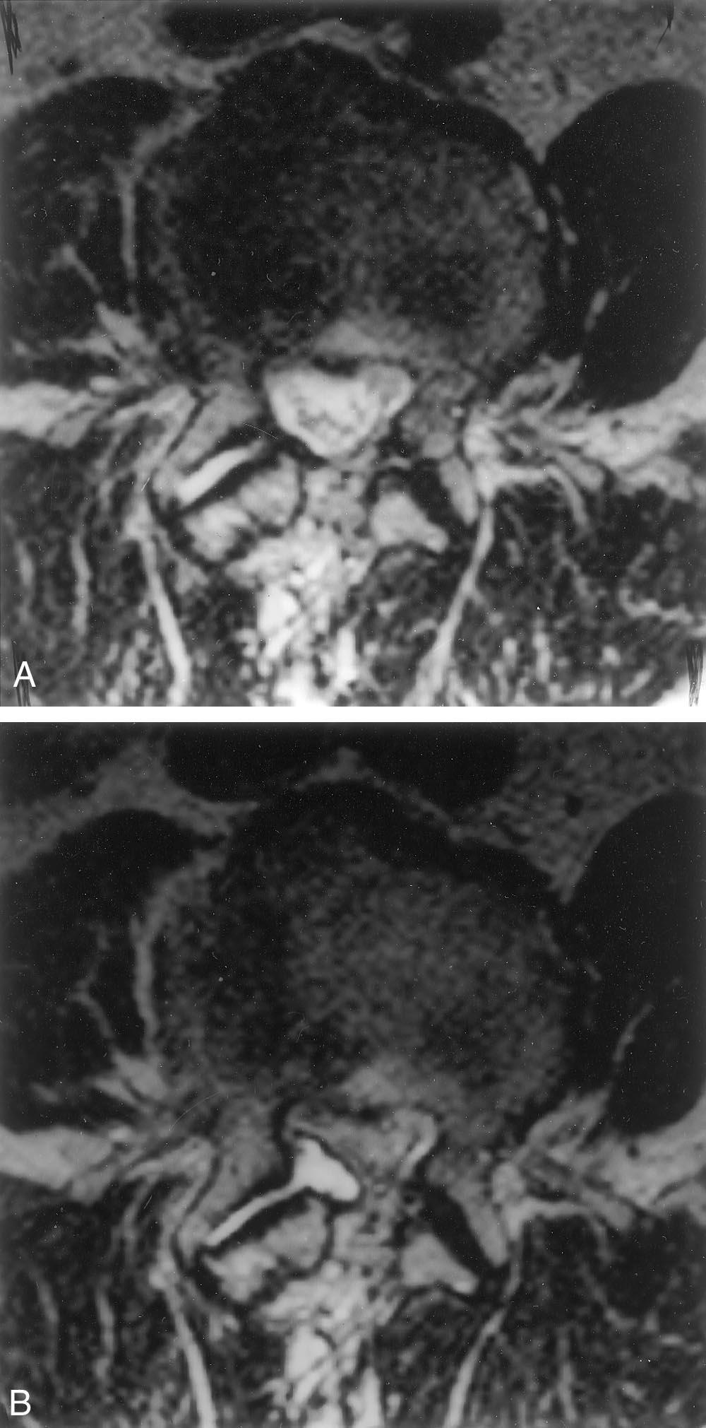 The cross-sectional area of the dural sac in disc level decreased significantly to an indisputable stenosis from (A) relaxed position (PRP) to (B) axially loaded position (ACE).