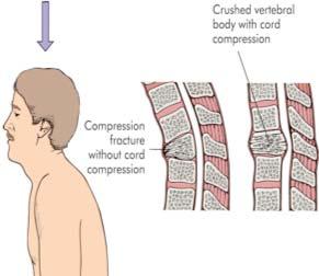 Injuries of the spine: