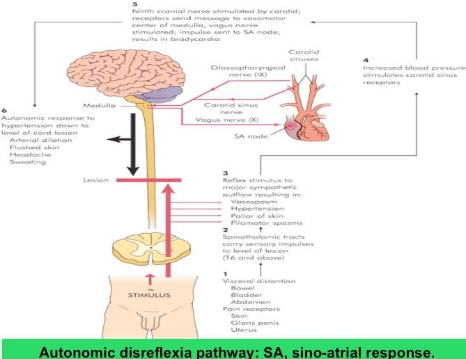 Autonomic disreflexia pathway: SA, sino-atrial response.