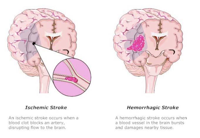 to the brain Hemorrhagic stroke: occurs when a blood vessel in the brain bursts and damage nearby