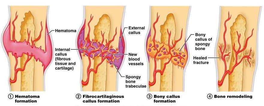 Bone Repair Fractures are breaks in bones, and are classified by: 1. The position of the bone ends after fracture, 2. Completeness of break, 3.