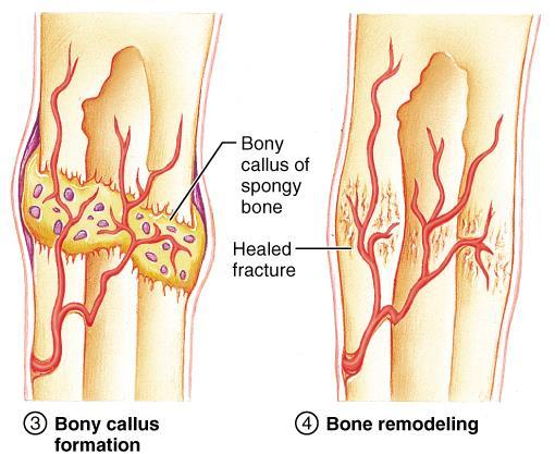 Fracture Repair Step 3: A. Bone trabeculae increase in number and convert the fibrocartilaginous callus into a bony callus of spongy bone. Typically takes about 6-8 weeks for this to occur. Step 4: A.