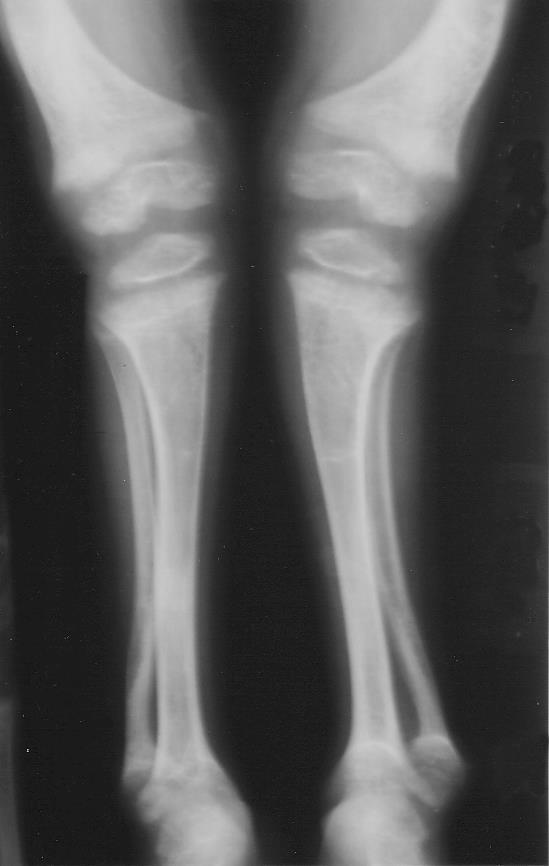 Clinical Conditions Osteomalacia Literally soft bones. Includes many disorders in which osteoid is produced but inadequately mineralized.
