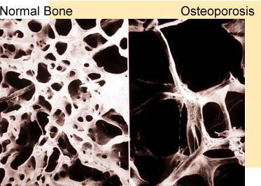 Clinical Conditions Osteoporosis Group of diseases in which bone resorption occurs at a faster rate than bone deposition.