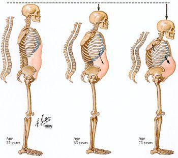 ADULT BONE When we age o Loss of collagen (elasticity) o Increase in bone brittleness Bone