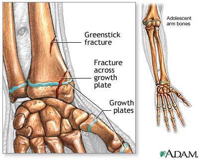 Bone Development & Growth EPIPHYSEAL DISK (growth plate) is a band of cartilage between the epiphysis and
