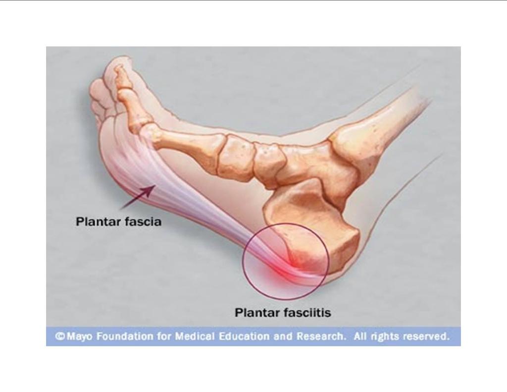 -inflammation of the plantar fascia -