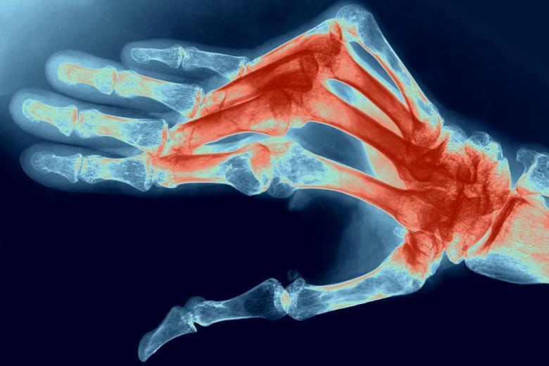 4. Rheumatoid arthritis is an autoimmune disease which causes joint stiffness
