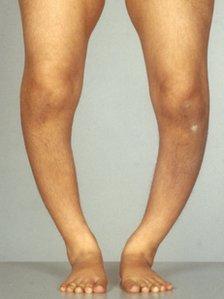 4. Rickets This preventable bone disease affects