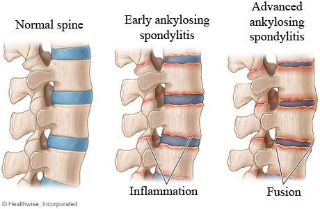 ABNORMALITIES OF THE SPINE ANKYLOSIS is severe