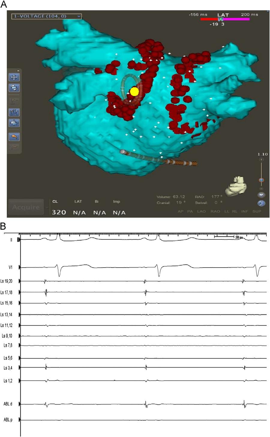 2008 Heart Rhythm, Vol 9, No 12, December 2012 Figure 4 A: Catheter-projection view of the Lasso in the ostium of the left inferior pulmonary vein, with superimposition of subsequently applied repeat