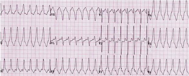 ECG Features of VT originating from basal IVS Left bundle block with early precordial transition (V 1 V 2 ) Endocardial mapping was performed in all (LV in 8, RV in 4);