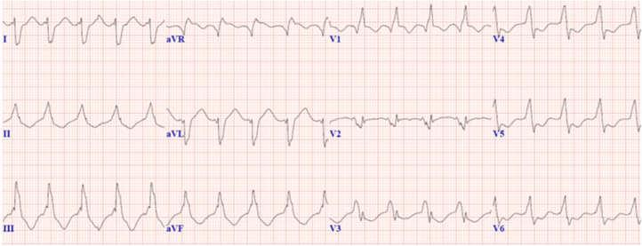 Right bundle block with unusual precordial transition At conclusion of percutaneous ablation, in 4 patients no VT was inducible, in 3 patients clinical VT remained