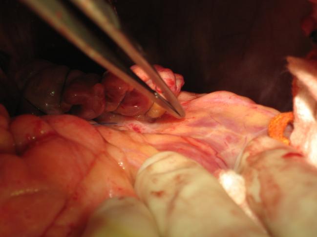 Surgical Ablation: Alternative Approaches Trans-mitral approach: This offers best visualization of both papillary muscles, posterior LV endocardium and LV apex.