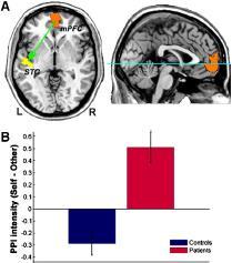 Source Memory Deficits in Schizophrenia Altered patens of neural activity during