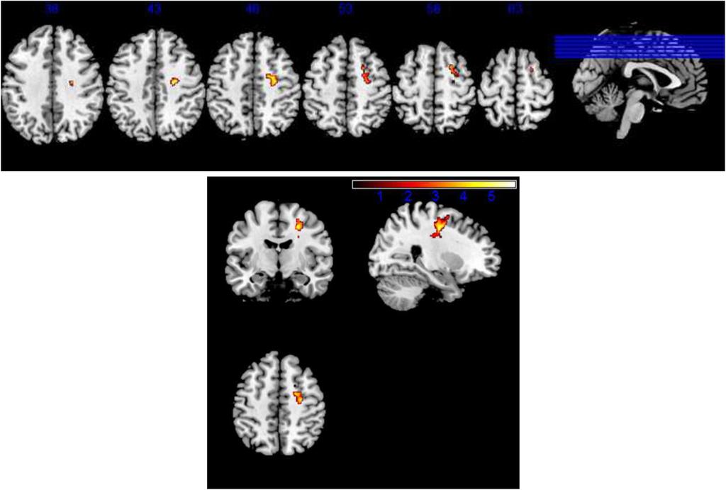 Kang et al. Chinese Neurosurgical Journal (2015) 1:9 Page 5 of 5 Fig. 3 Negatively correlated brain region between gray matter volume and HY in PD patients. The threshold for display was set to P < 0.