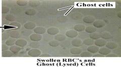 might be effected by urine concentration Ghost cell (erythrocyte cell membrane) Faint RBC which is exposed to