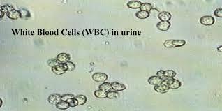 Microscopic examination of urine - WBC Presence of abnormal number of WBC in urine is