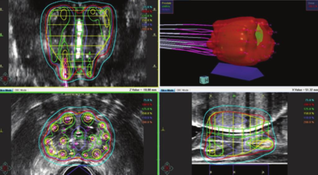 A B FIGURE 1. Clinical dosimetry of ultrasound-based (A) and CT-based (B) high dose rate (HDR) brachytherapy planning.