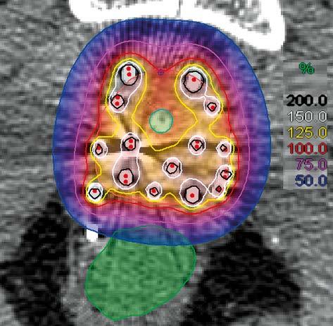 HDR brachytherapy as monotherapy for prostate cancer 93 A B C Fig. 1. A) Preparation for implant of applicator needles for HDR prostate brachytherapy.