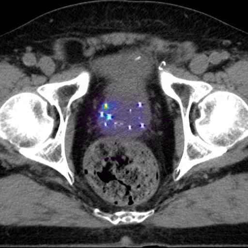 Figure [5] an axial CT slice with a dose distribution overlain. Colors closer to the red spectrum indicate a higher dose relative to the blue colors.