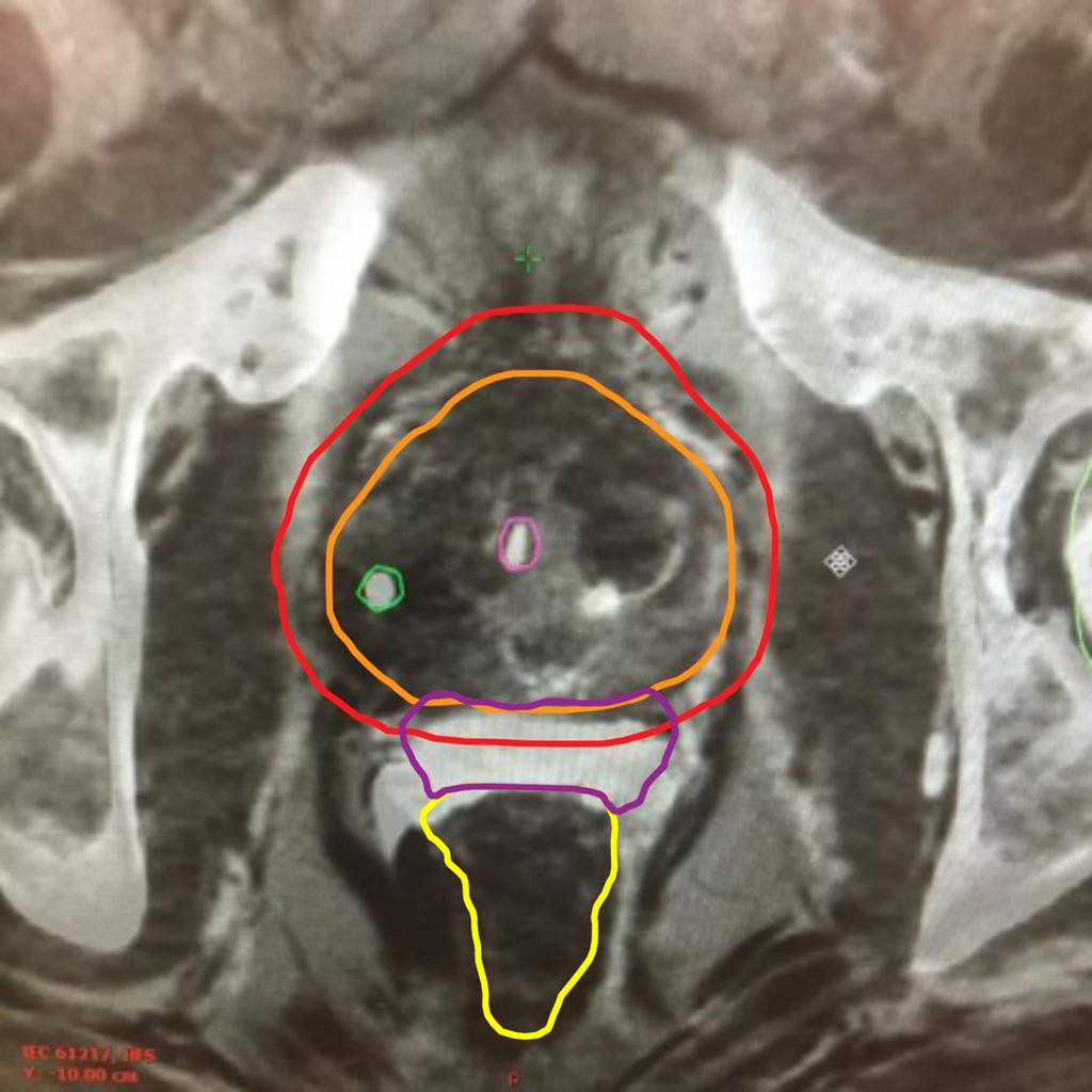 FIGURE 1. Merged Axial T2 MRI and CT Simulation Image of a Patient With SpaceOAR Hydrogel and Calypso Beacons. The image shows SpaceOAR hydrogel spacing the prostate anteriorly and rectum posteriorly.