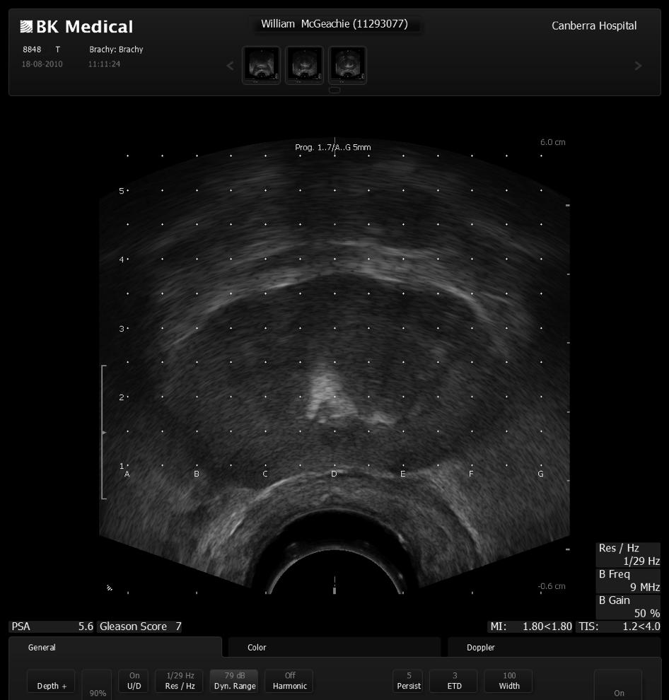 VOLUME STUDY Images captured from base to apex at 5mm intervals Measurements taken and documented: width, height, length and volume Risk of pubic arch interference observed and documented