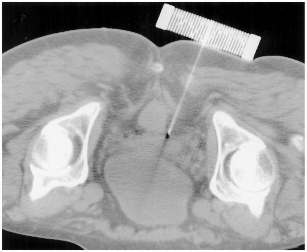 33 Fig. 1. CT image of 3-D CT-guided stereotactic pararectal biopsy needle placement into the seminal vesicles. The rectum and coccyx is spared.