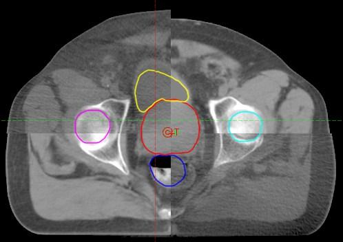 used for imaging the patients that included 120KV, 80 ma and full scan with a half bowtie filter. Fig 5.1- Soft tissue alignment for daily CBCT with respect to Planning CT 5.