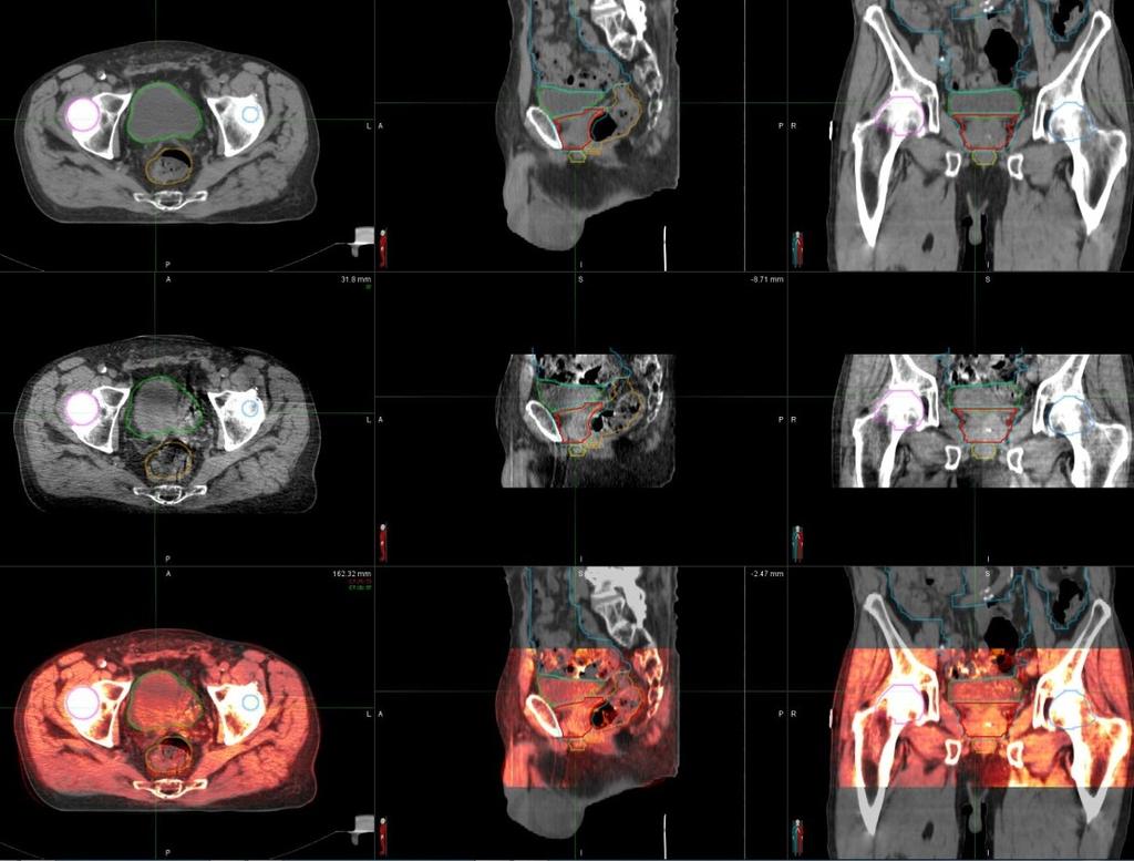 Fig 5.3- Image registration for Daily CBCT and Planning CT in MIM 5.