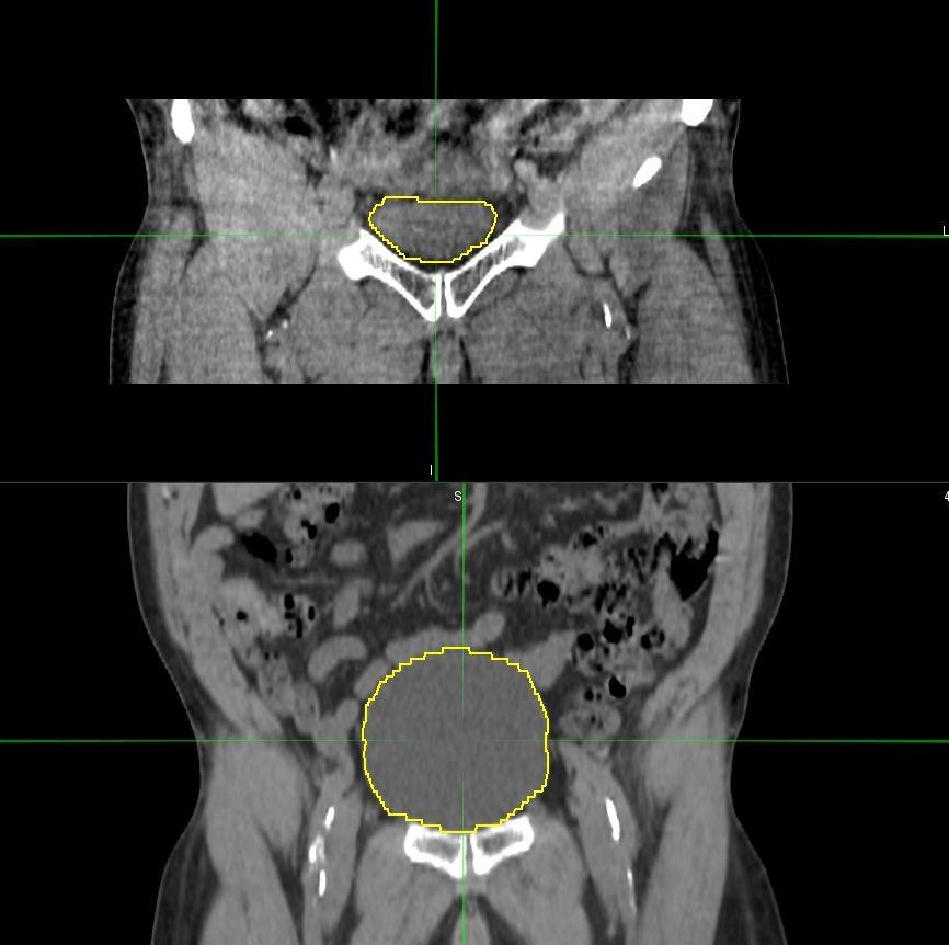 Fig 6.11 shows the coronal view of bladder volume for daily CBCT and planning CT for Patient1.