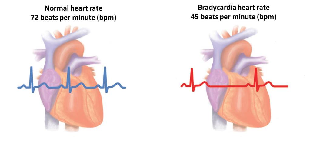 Bradycardia - When the heart beats too slowly Bradycardia is a slow or irregular heart rhythm, usually less than 60 beats per minute.