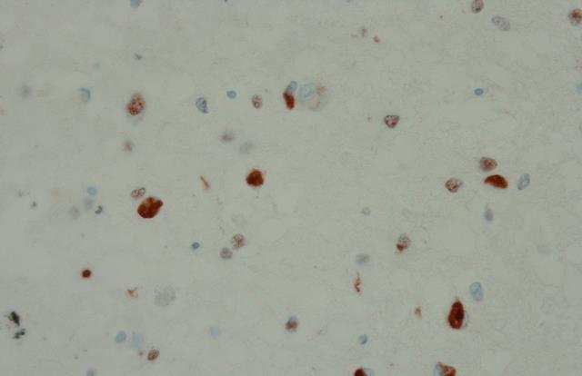 neurites and intranuclear inclusions Type B: In