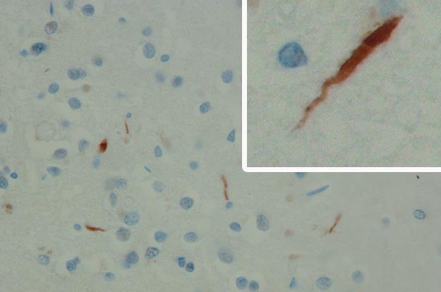 cytoplasmic inclusions Type C: In neocortex there