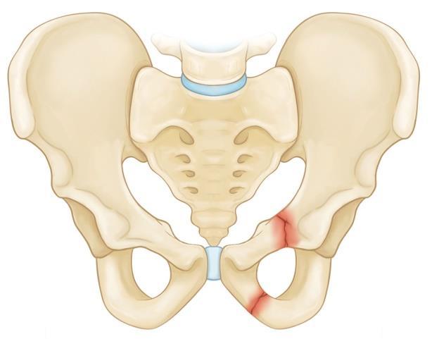 the iliac bone. At pubis: Pectineal line which is ramus.