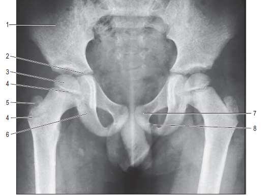 Anteroposterior radiograph of the pelvis of a boy aged 7. 1. Ilium. 2. Part of triradiate growth cartilage. 3.