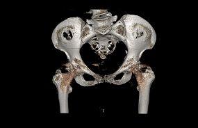 Suggested Clinical Correlates (CC): Left Acetabular Component of Left Hip Arthroplasty Extends Into Fat and Soft Tissue Without Nerve Impingement Right Acetabular Component of Total Right Hip