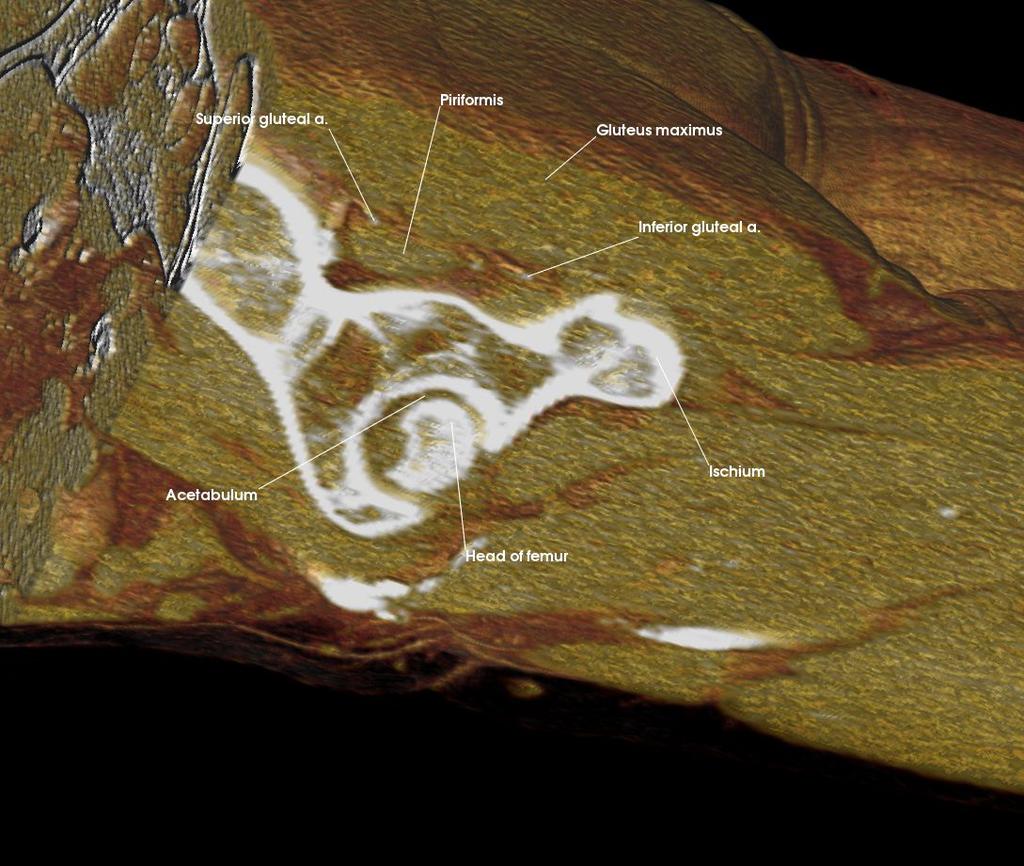 Acetabulum Gluteus maximus Head of femur Inferior gluteal a. Ischium Piriformis Superior gluteal a. 1. c.