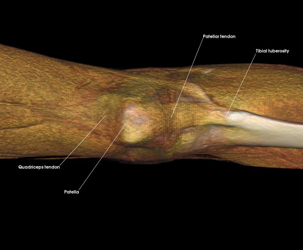 Patella Patellar tendon Quadriceps tendon Tibial tuberosity 2. d.